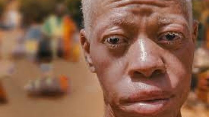 We Are One Movie: Broulaye, a leader in the albino commuity of Mali