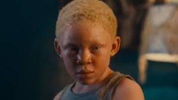 Can You See Us?: A boy with albinism